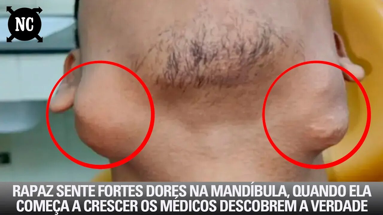 Rapaz Sente Fortes Dores Na Mandíbula, Quando Ela Começa A Crescer Os Médicos Descobrem A Verdade