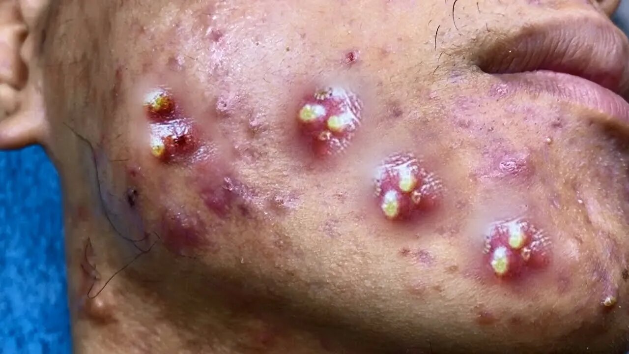 Big Cystic Acne Blackheads Extraction Blackheads & Milia, Whiteheads Removal Pimple Popping