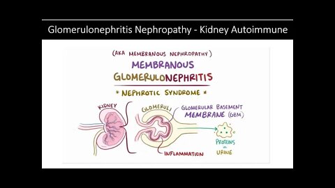 Kidney Autoimmune Glomerulonephritis Nephropathy - Natural Treatment