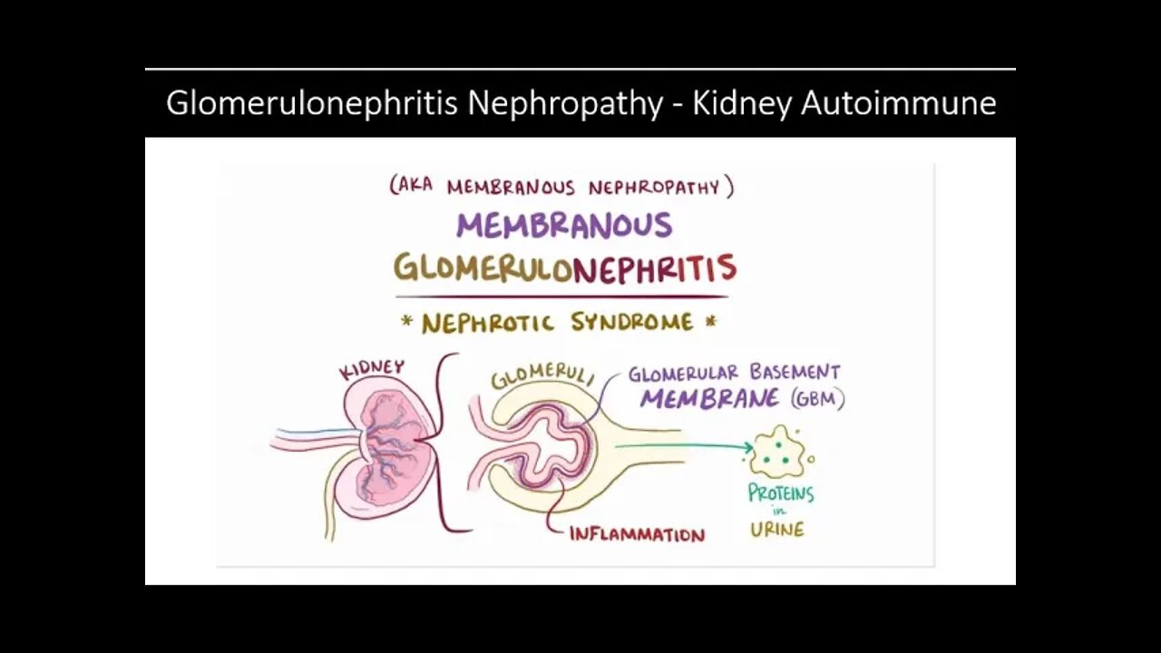 Kidney Autoimmune Glomerulonephritis Nephropathy - Natural Treatment