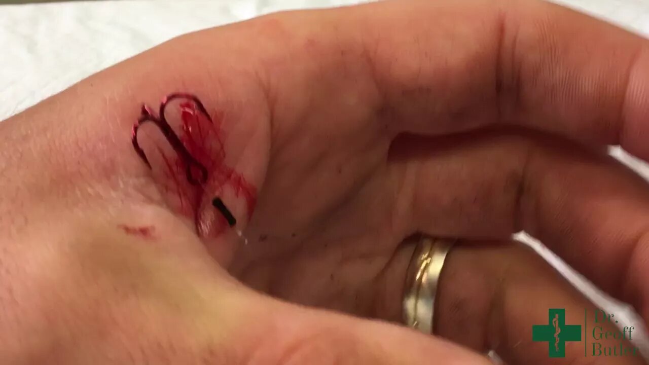 Removal of a Fishing Barb from the Hand