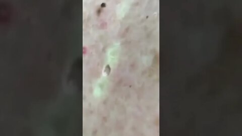 Satisfactory Video Blackhead Removal Skin Cleansing #18 | 2022 Video