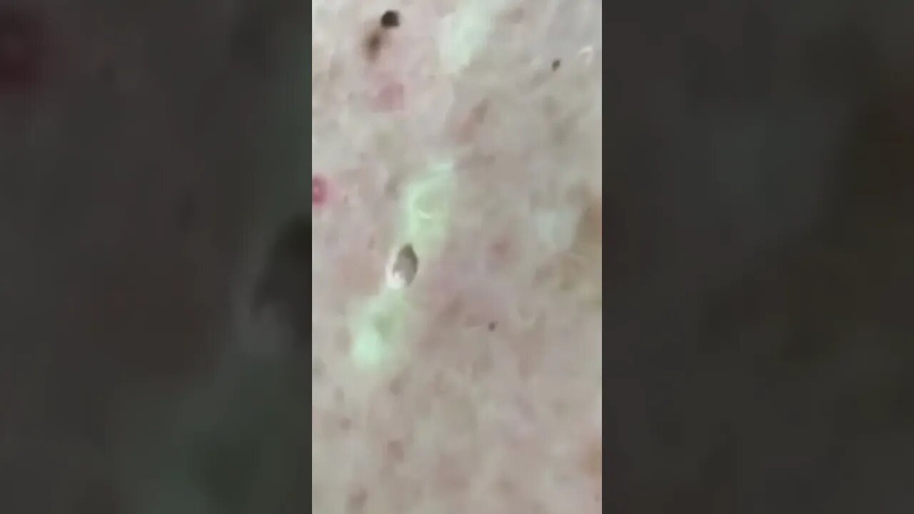 Satisfactory Video Blackhead Removal Skin Cleansing #18 | 2022 Video
