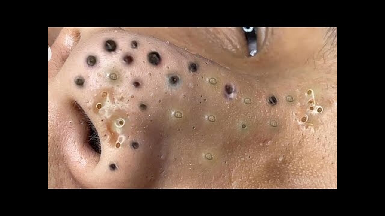 Satisfying Blackheads Cystic Acne Extraction on Ear | Dr. Pimple Popper