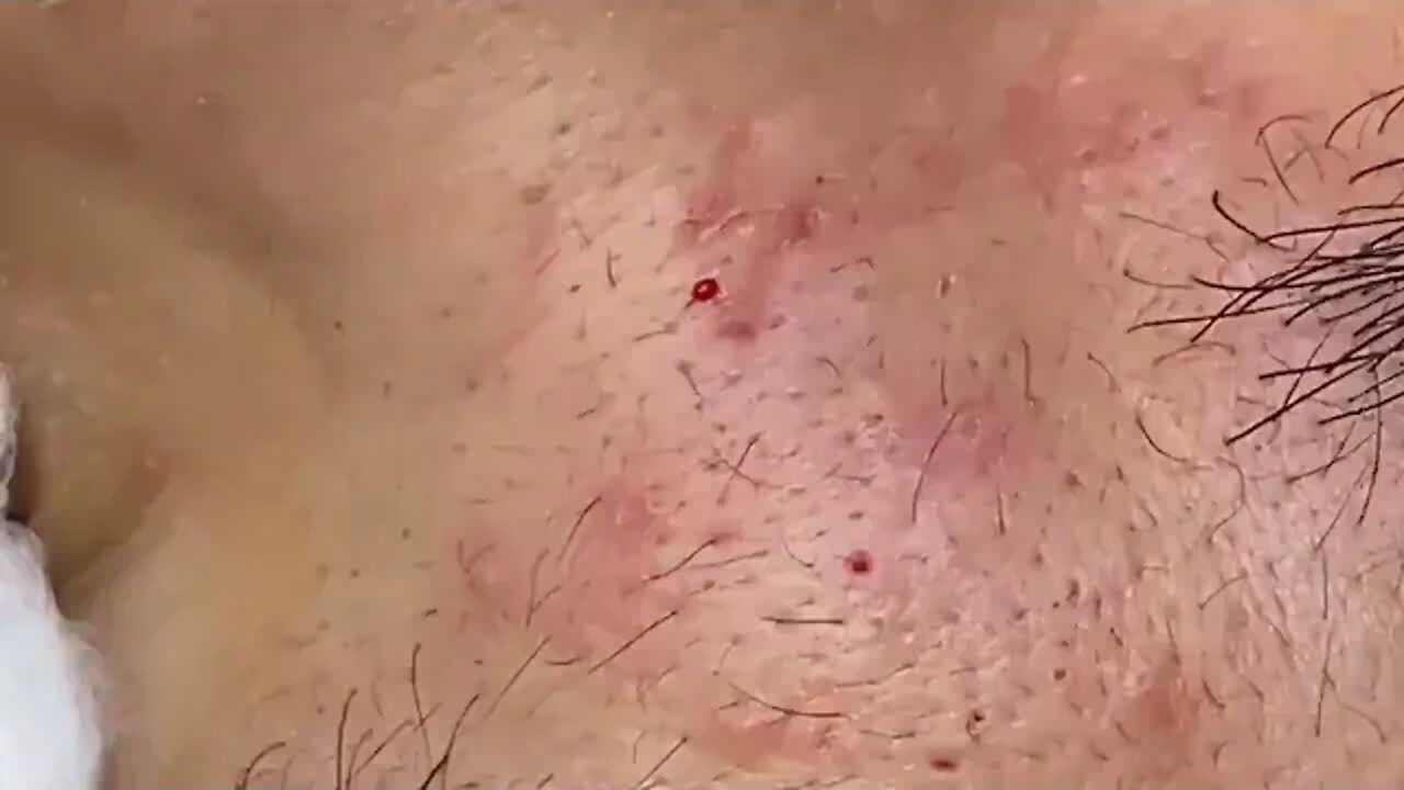 Removal / extraction of blackheads and pimples!