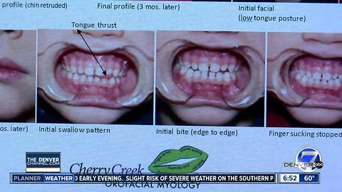 Orofacial myology: Training face muscles for long term change