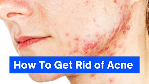 eliminate your acne