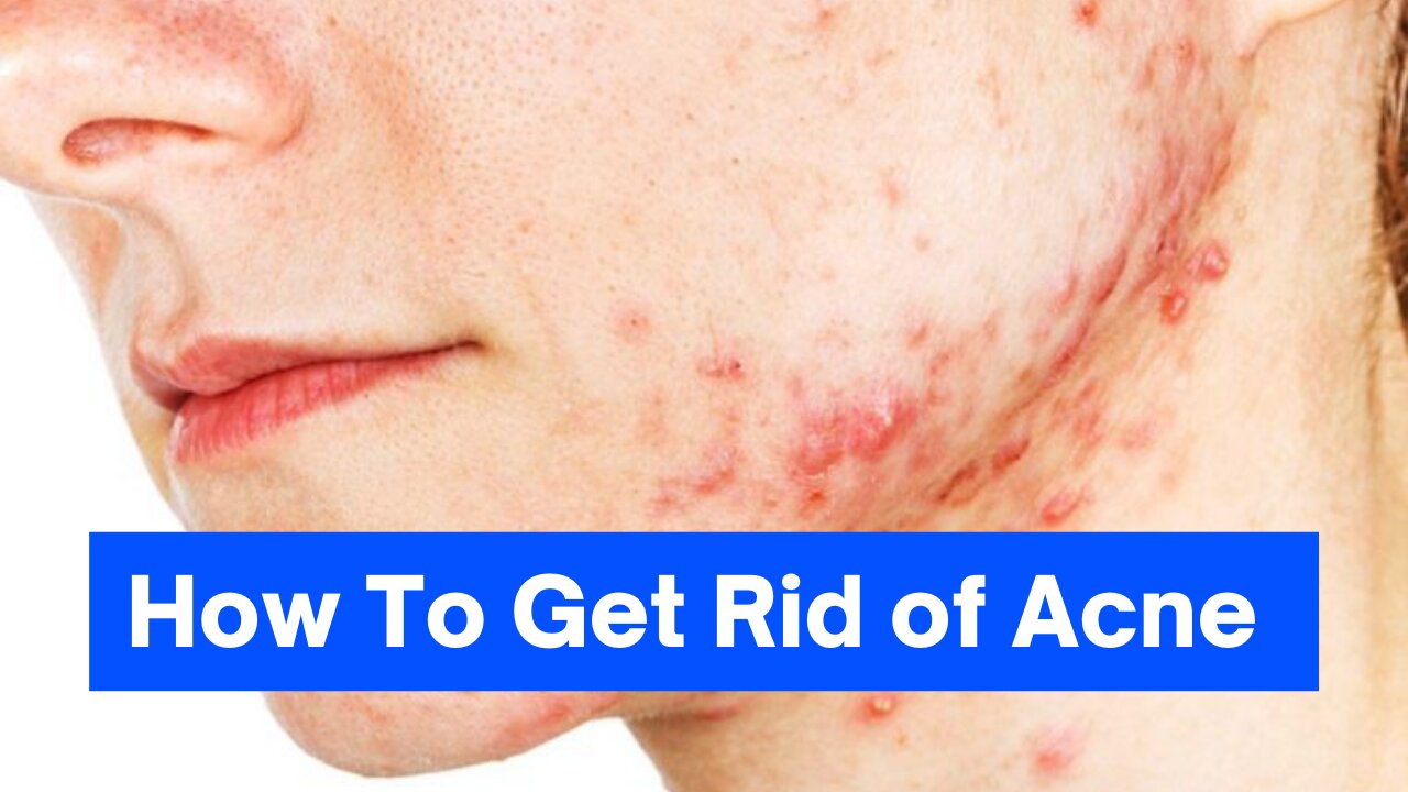 eliminate your acne