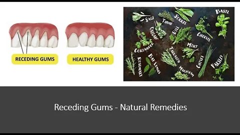 Receding Gums Natural Treatment