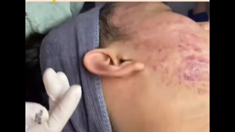 Pimple popping. Blackheads