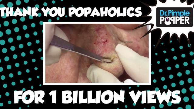 Dr Pimple Popper: THANK YOU, POPAHOLICS FOR ONE BILLION