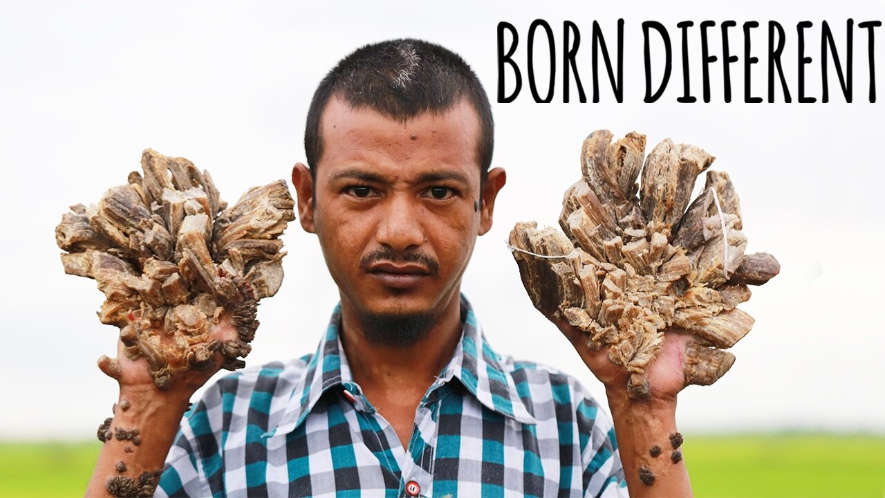 They Call Me 'The Tree Man' | BORN DIFFERENT