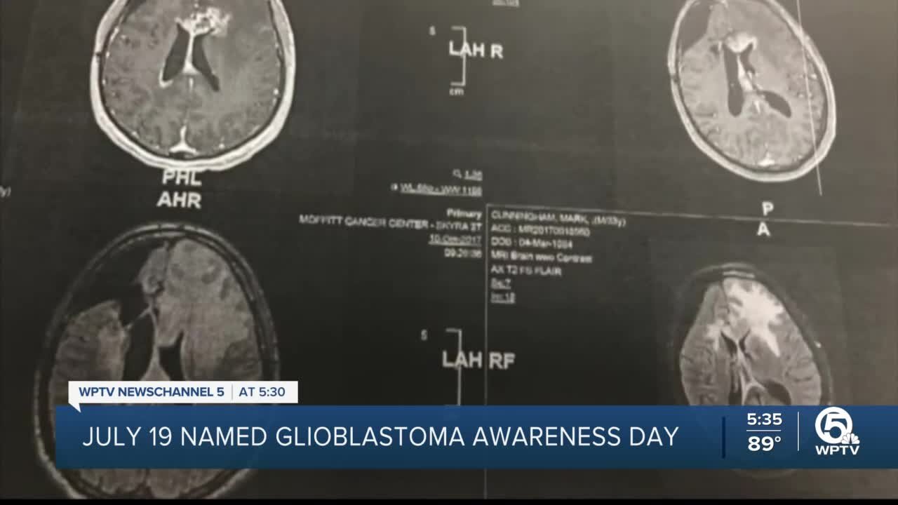 South Florida glioblastoma cases continue to raise questions