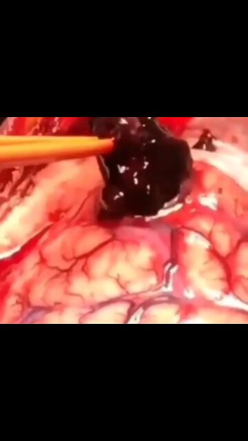 HUGE Clots from the "Vaccine" in Man's Brain #JustSayNo