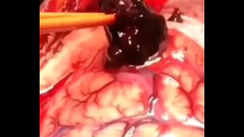 HUGE Clots from the "Vaccine" in Man's Brain #JustSayNo