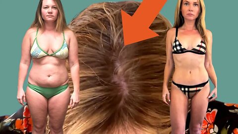 Ozempic weight loss before and after vs Gastric Sleeve: Did Semaglutide Ruin My Hair?