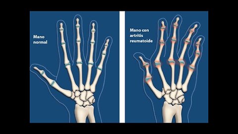 ARTRITIS ARTROSIS Y ARTRITIS REUMATOIDE QUE LA PROVOCA Y SOLUCION