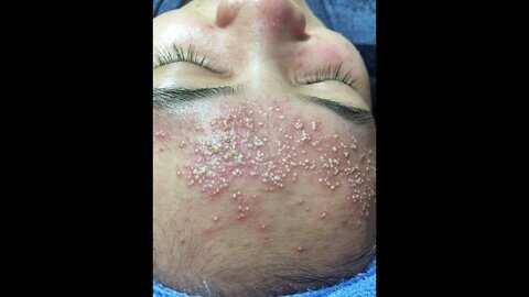 Blackhead Removal, Pimple popping, Acne Treatment #97