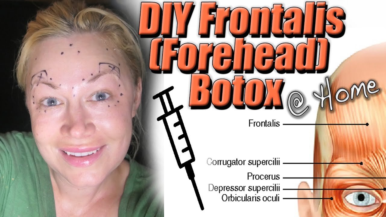 How I DIY Frontalis (Forehead) Botox at home | Code Jessica10 saves you Money