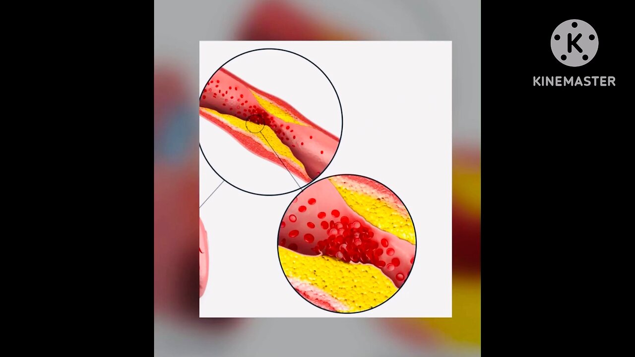 Heart||myocardial infraction||treatment||Heart disease