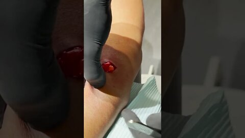 Remoção de Cravos e Espinhas - Remove Squeezing Blackheads and Pimples - Just Relax | Apenas Relaxe