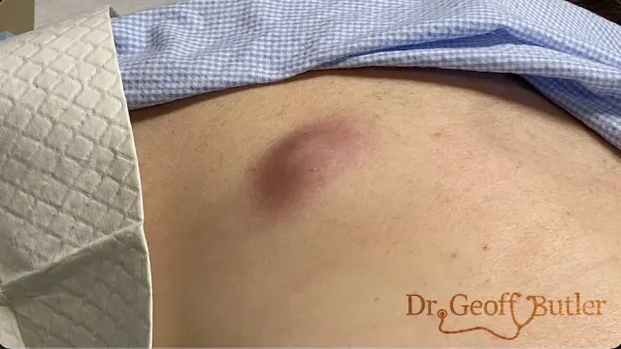 Drainage of an infected cyst on the back