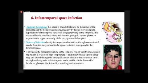 Oral surgery L15 part2 (Odontogenic infections)