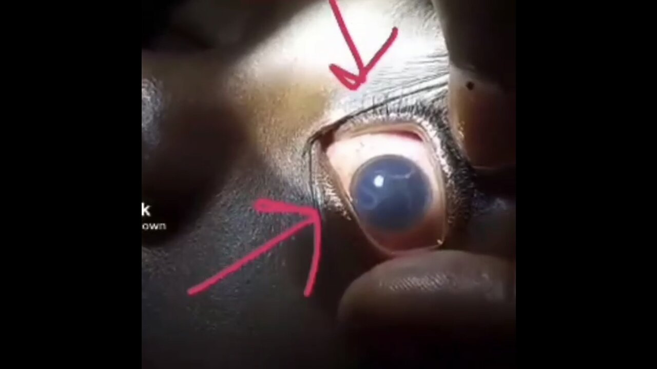 Little boy who died because of the vaccine 💉 has a parasite in his eye 👁️ ball