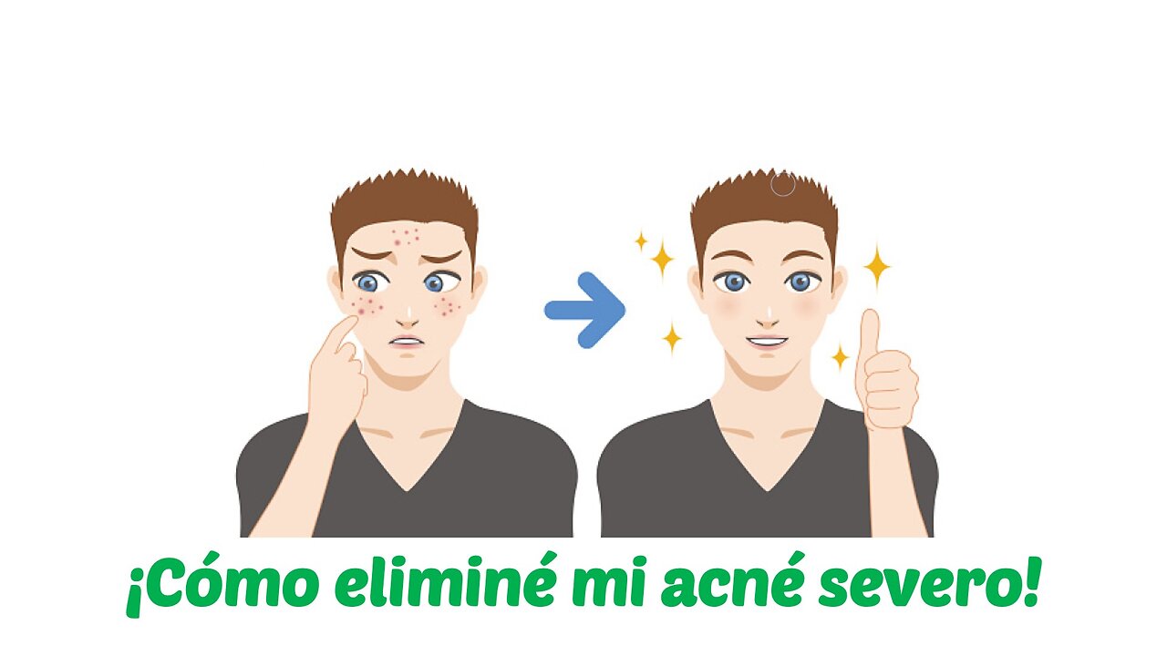 ¡Cómo eliminé mi acné severo!