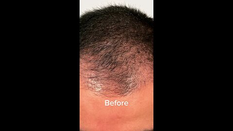 considering hair restoration?