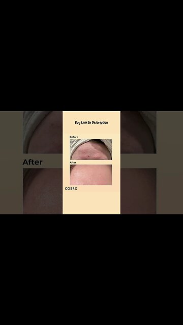 COSRX Hydrating Serum for Face #shorts #hydrating #serum #facecare #amazonfinds