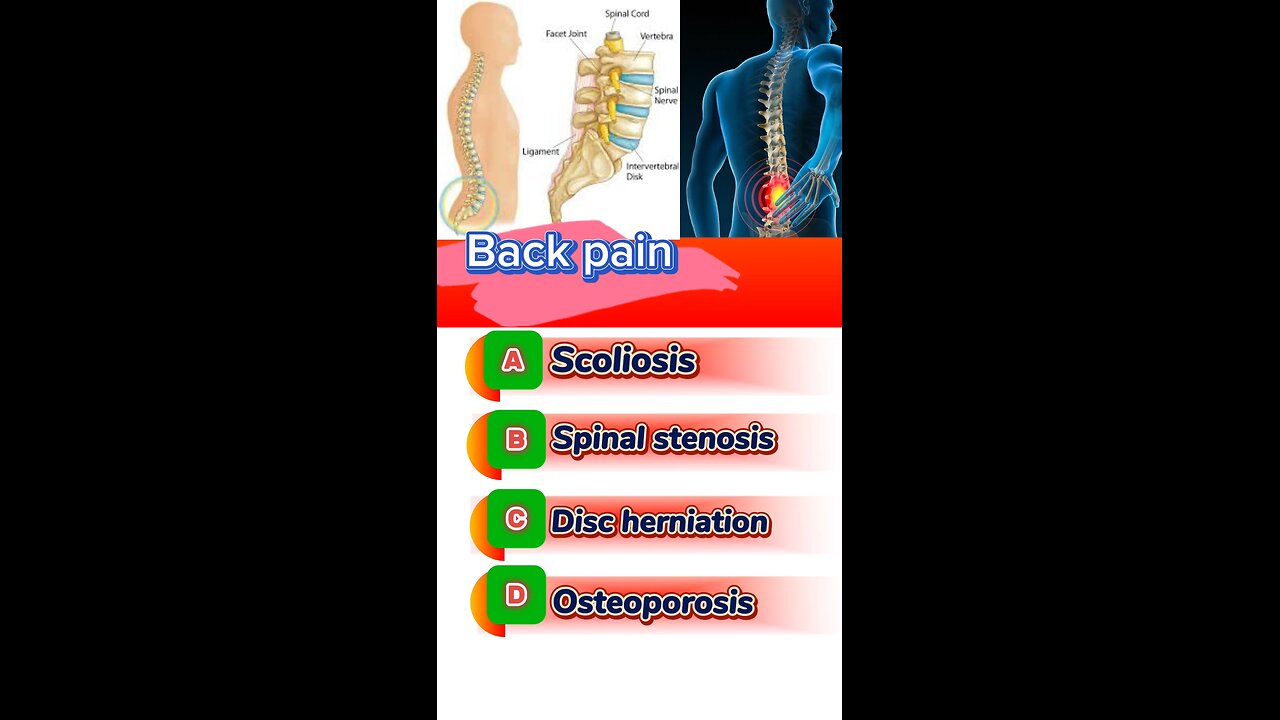 Back pain question answered mcqs #pain #joinpain #pain #medication #painkiller #drugs