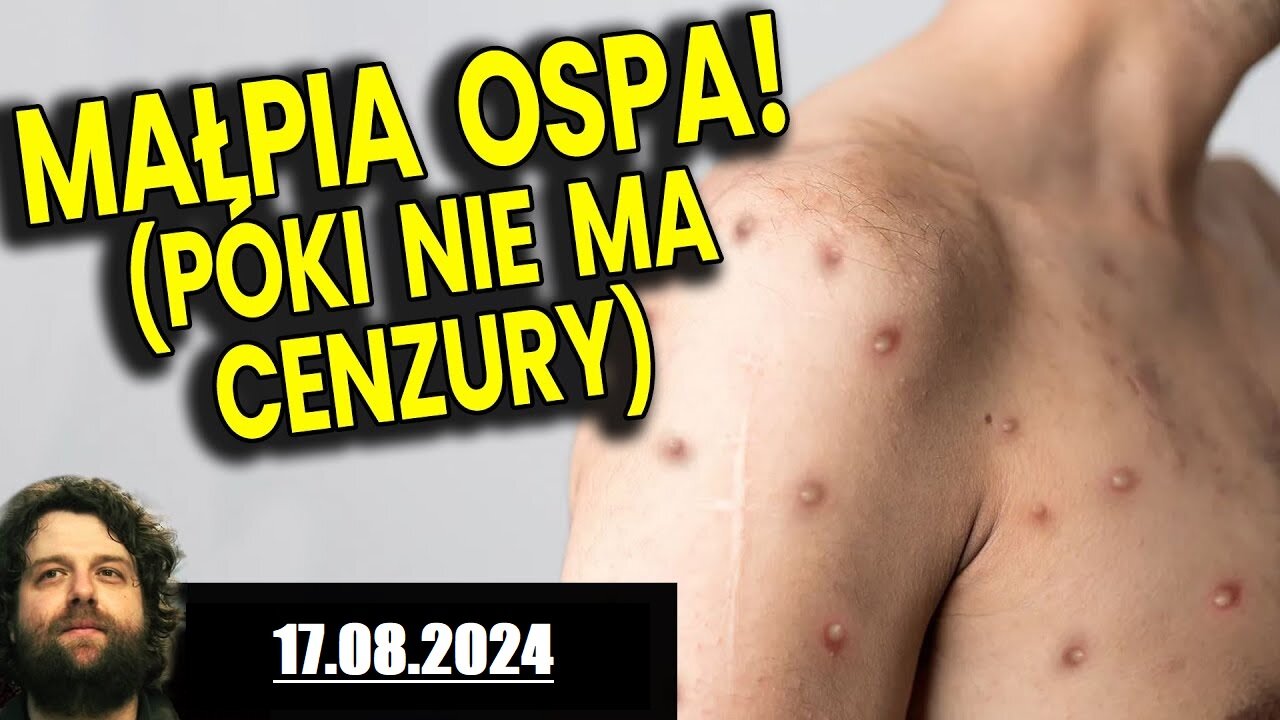 Małpia Ospa! Mpox! - Co mówią Lekarze i Naukowcy (17.08.2024)