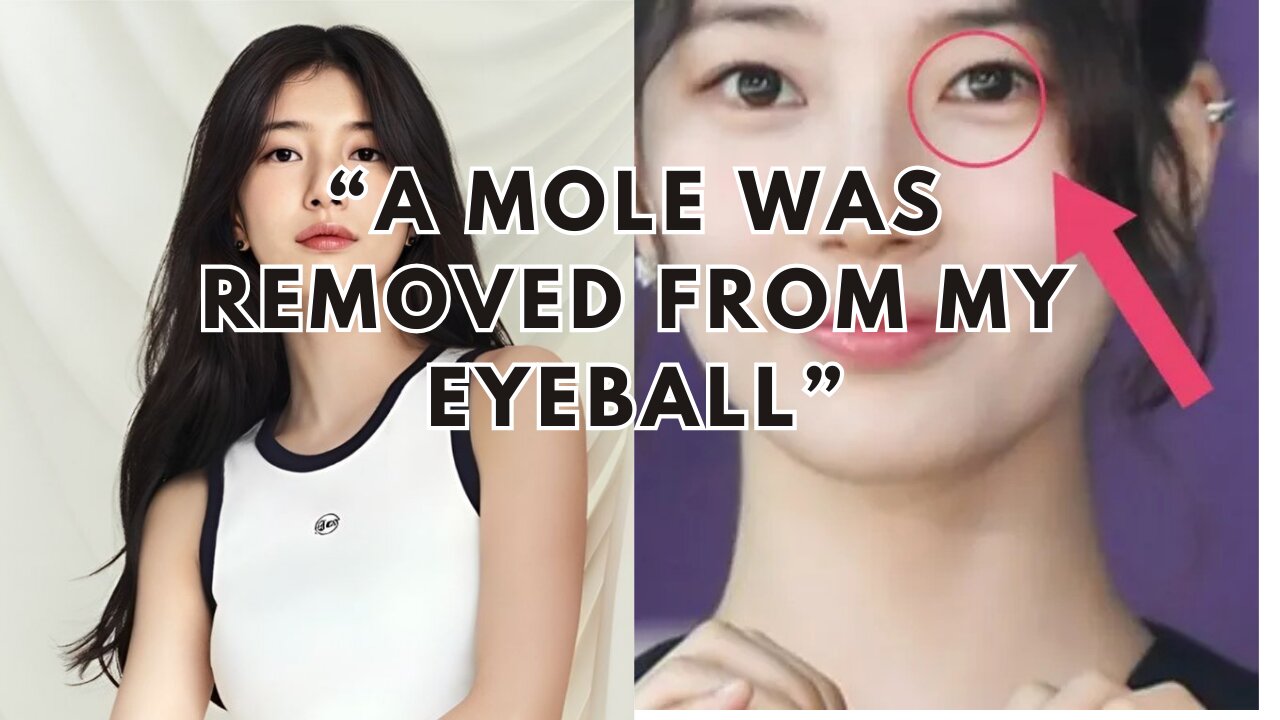 Suzy Eyeball Mole Removal Reveals Stunning Transformation