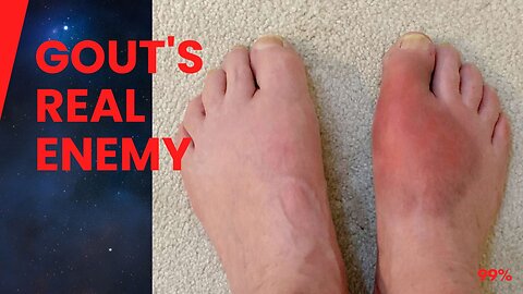 The Shocking Truth Behind Gout - It's Not Just Meat!