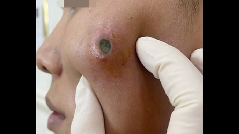 blackhead