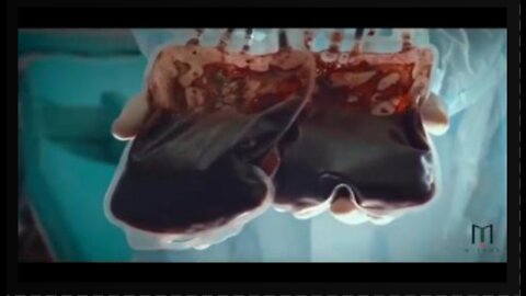 VAXXED Blood - The Issue of Transfusions from the Vaxxed! I don't want it. Do you?