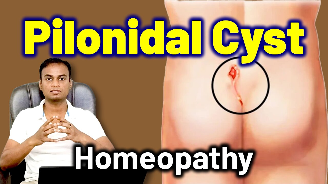 Pilonidal Cyst and Homeopathy Treatment Cure Medicine Surgery | Pilonidal Cyst Sinus Abscesses