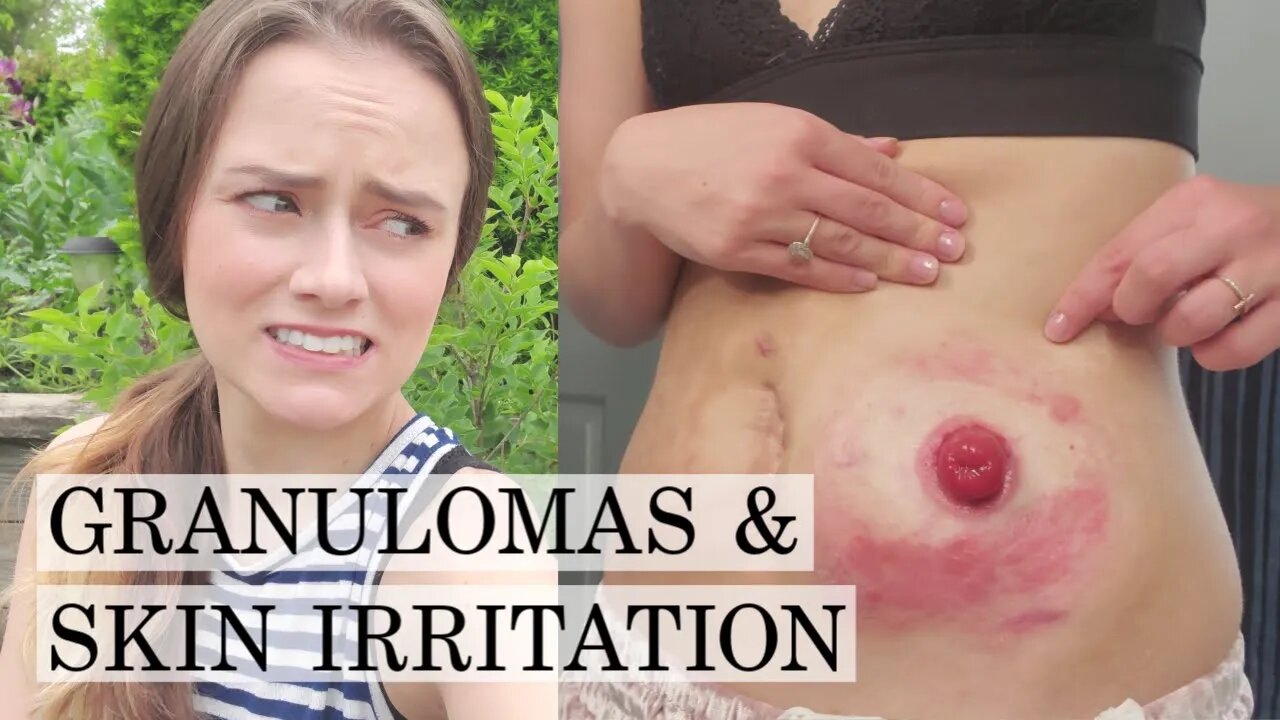 Treating Granulomas & Skin Irritation with an Ostomy | Let's Talk IBD