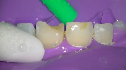 Chipped Teeth Repair with Bonding {Tooth Filling Replacement}