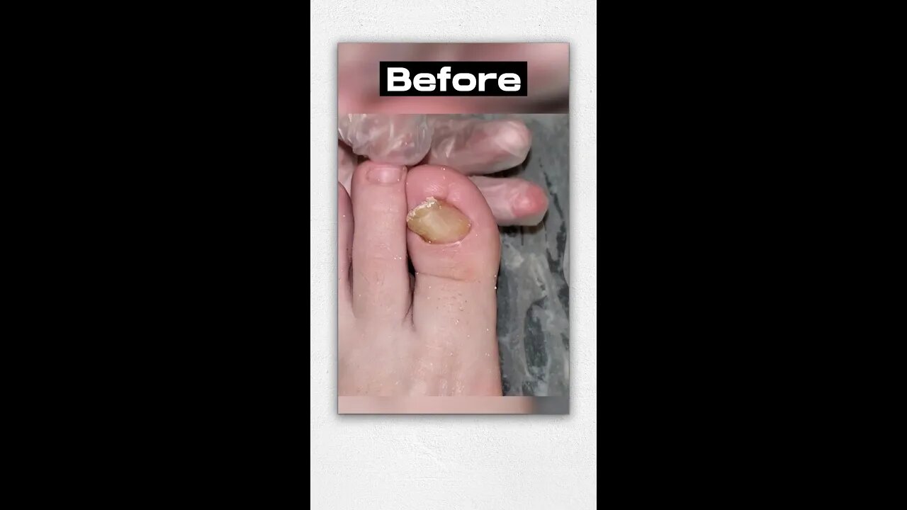 Thick Curved Nail Treatment By Miss Foot Fixer