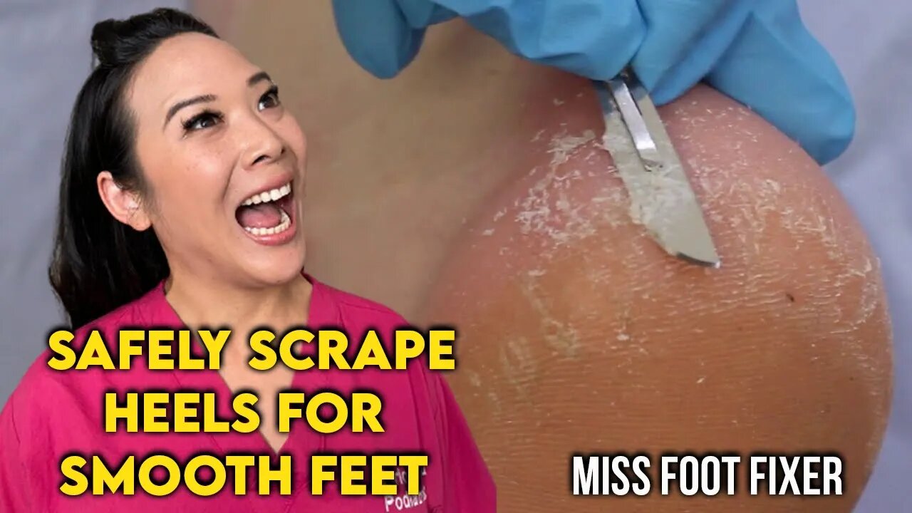 Safely Scrape Heels for Smooth Feet | By Famous Podiatrist Miss Foot Fixer