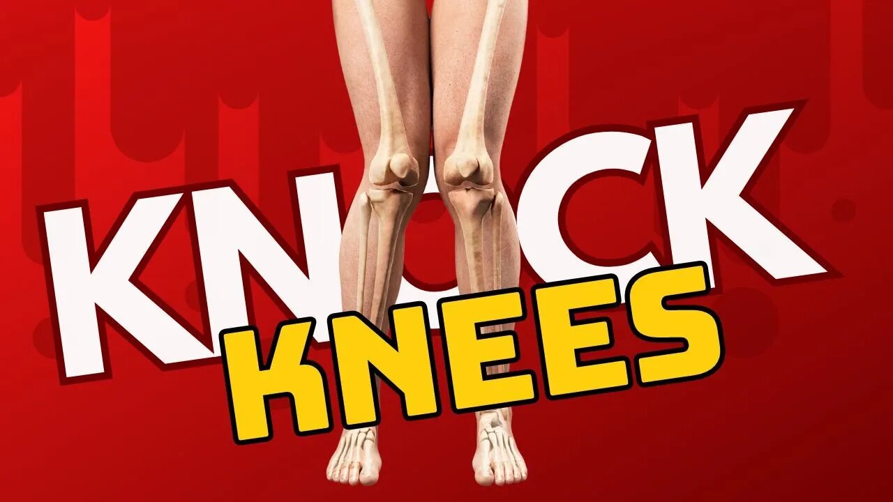 Knock Knees? Causes and Results. What causes your knees to "go in"?