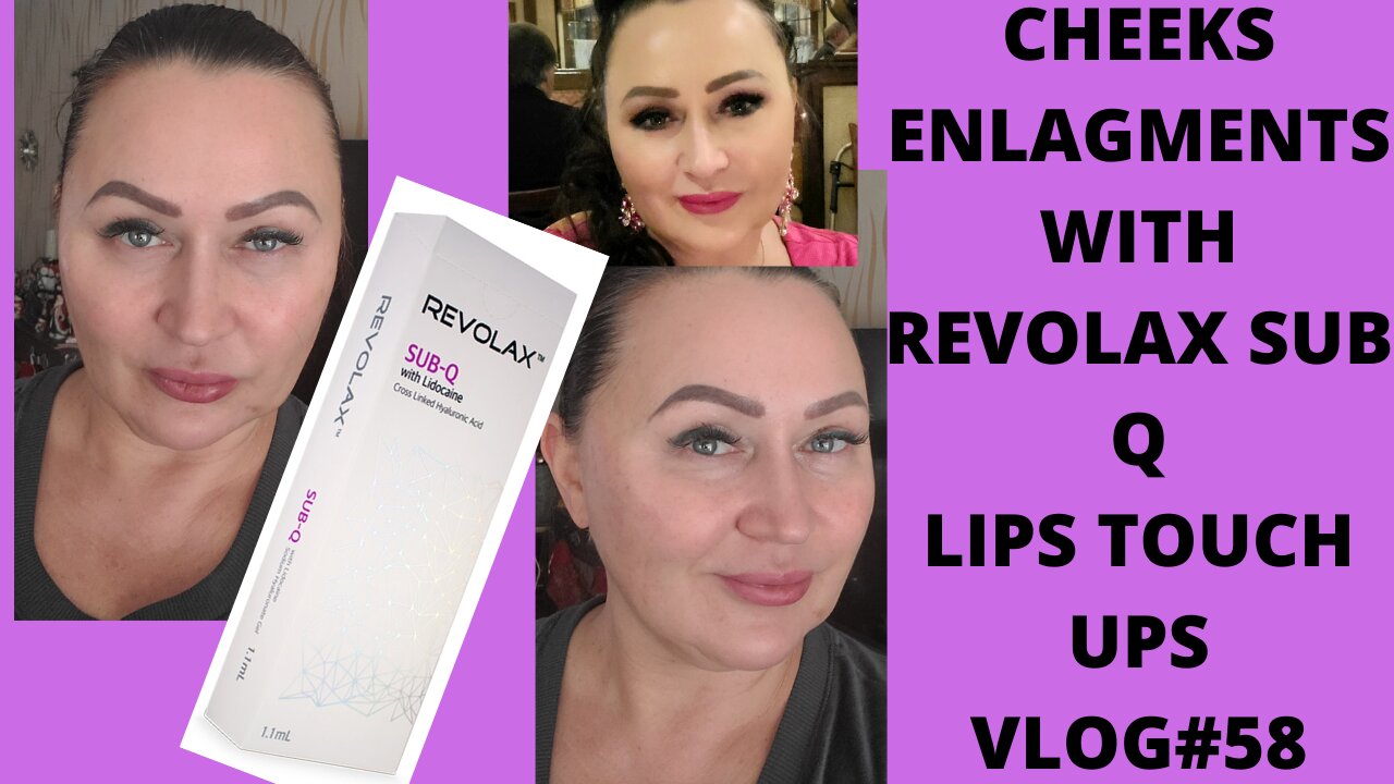 CHEEKS ENLAGMENT WITH REVOLAX SUB Q .VLOG#58 01.01.22 #cheekfillers #revolaxsubq