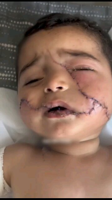 he lost his hand, got 200 stitches on his face & lost 9 members of his family in Gaza Palestine