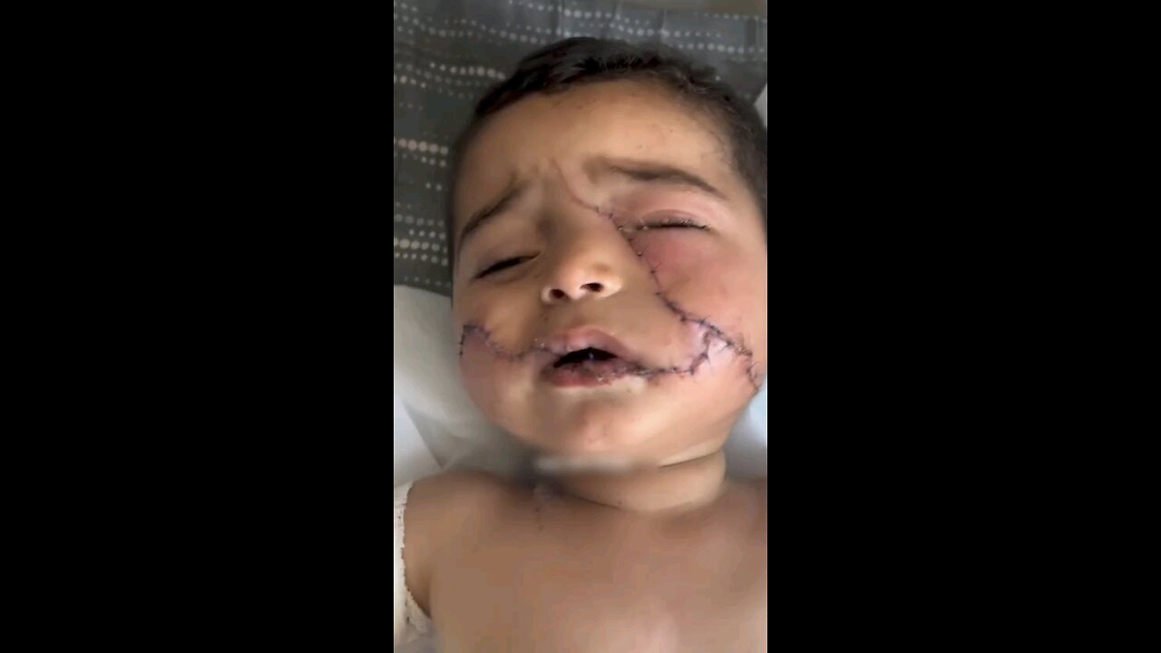 he lost his hand, got 200 stitches on his face & lost 9 members of his family in Gaza Palestine