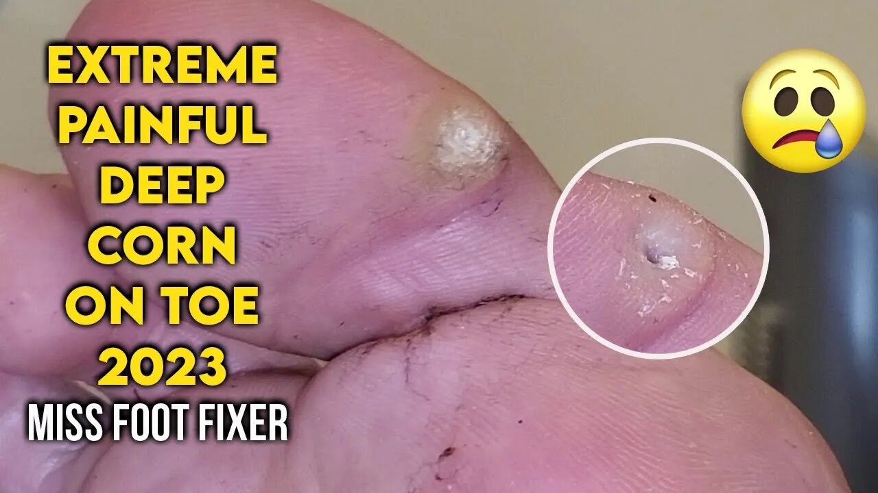 EXTREME PAINFUL DEEP CORN ON TOE 2023 PROPER TREATMENT BY FAMOUS PODIATRIST MISS FOOT FIXER