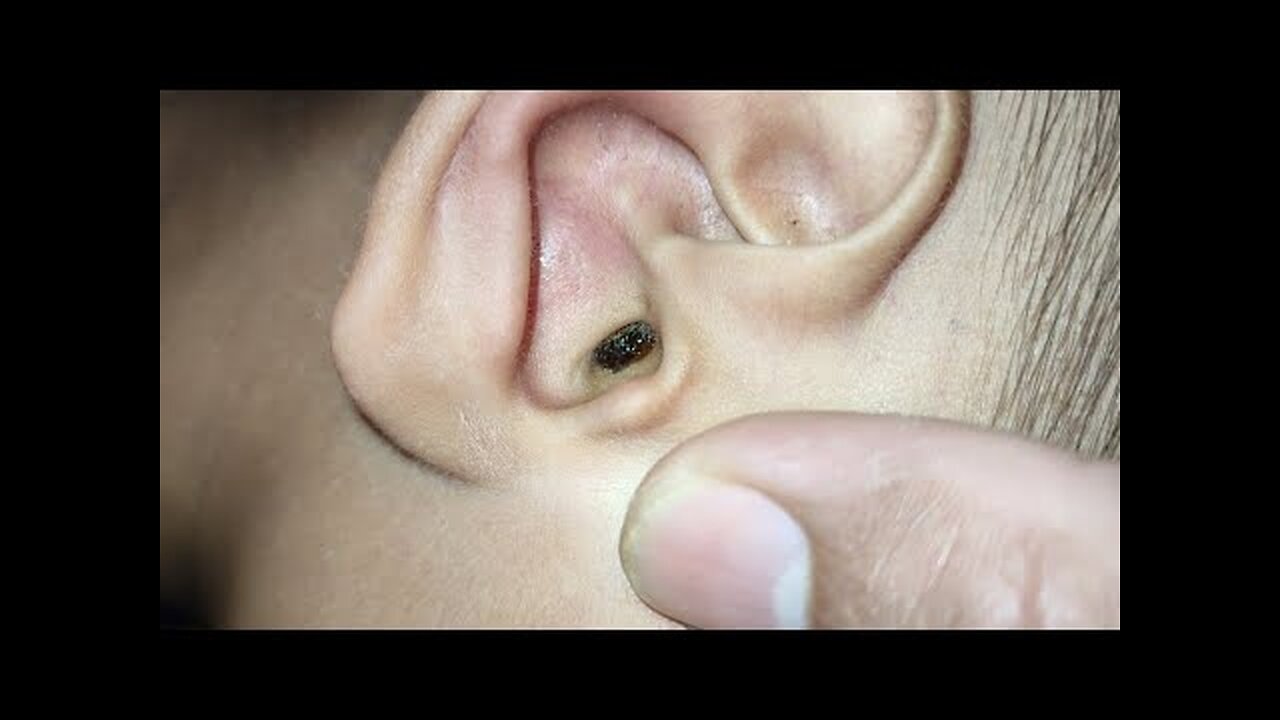 Relaxing earwax removal