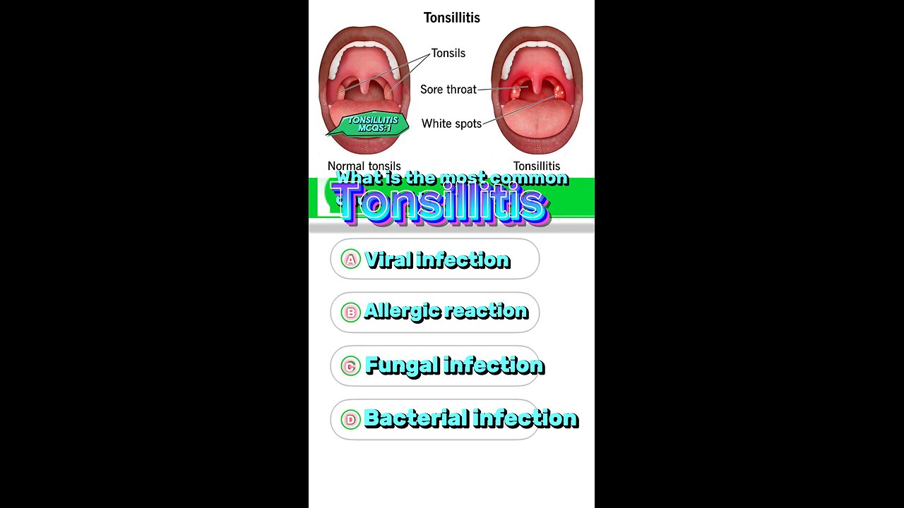 Tonsillitis mcq #gland #hormones #life #allergy #short #disease tonsillectomy