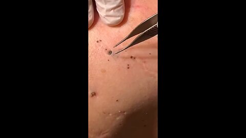 Pimples removal